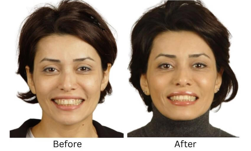 Oralift-case-1-before-850x512 The Houston Group