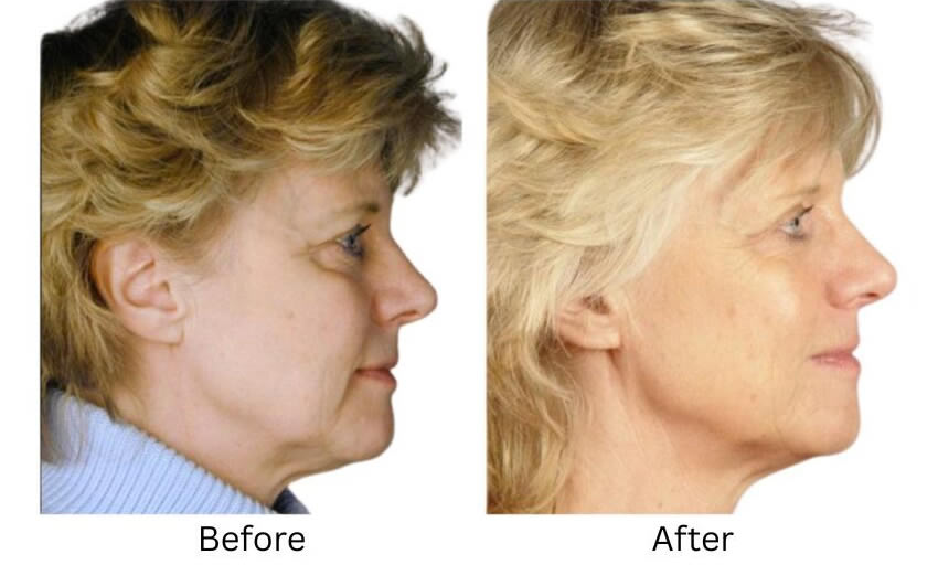 Oralift-case-3-before-850x512 The Houston Group